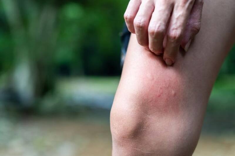 Treating Insect Bites and Stings: Expert Advice & What You Need to Know