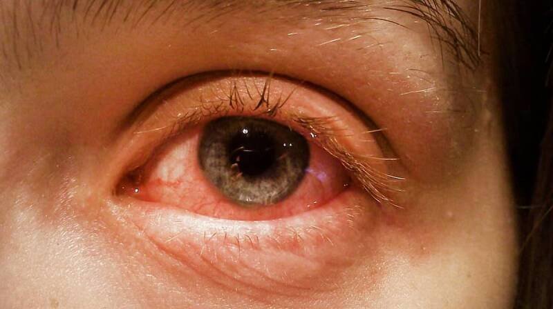 Vizag Conjunctivitis Outbreak: Understanding the Rise and Staying Safe